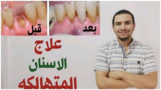 طرق علاج الاسنان المتهالكه و بقايا الجزور/ مش لازم خلع