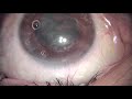 Egle ccc prechopper cataract surgery