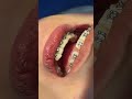 BRACE #shorts #teeth