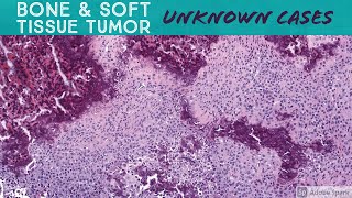 Soft Tissue & Bone Tumor Pathology Unknown Cases (Yale) (see video description for digital slides) screenshot 5