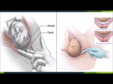 Video: CONDISOX- Voortgezet Versus Stopgezet Oxytocine Stimulatie Van Geïnduceerde Arbeid In Een Dubbelblinde Gerandomiseerde Gecontroleerde Studie