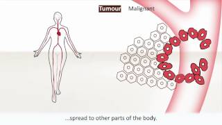 This animation gives information about cancer. it explains what cancer
is, how develops and the difference is between a benign malignant
tumour...