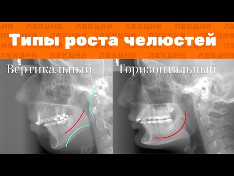 Лекция: Типы роста челюстей