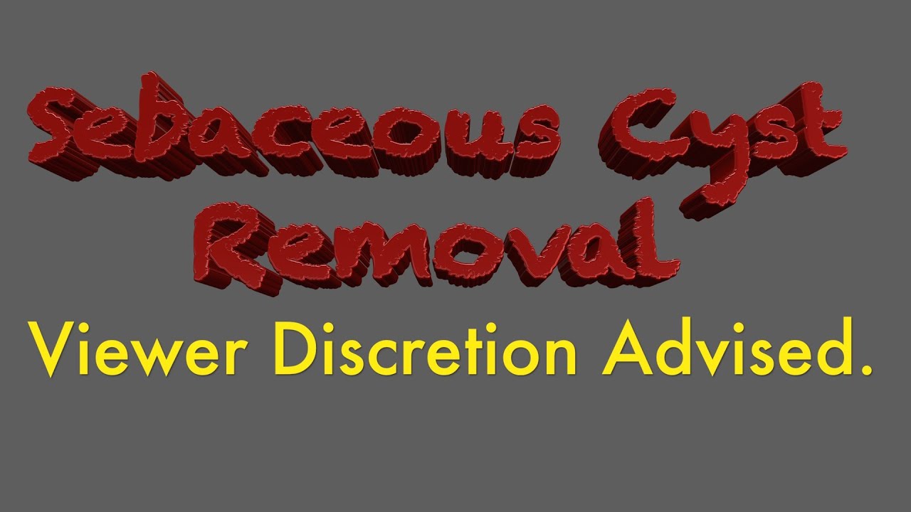 Sebaceous Cyst Medically REMOVED from Under Breast YouTube