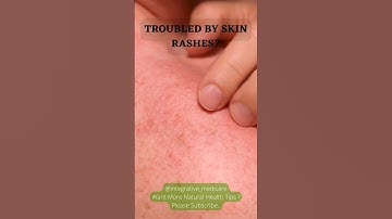 Skin Rash Natural Remedy! #youtubeshorts #shorts #viral #skincare #skinrashes #integrative_medicare