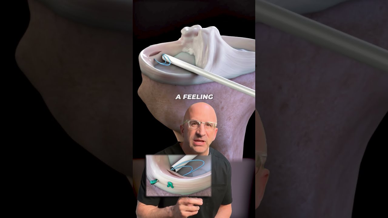 How Does It Feel To Tear Your Meniscus Top MeniscusInjury Signs