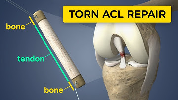 Torn ACL Reconstruction using a BPTB graft (Bone-Patellar Tendon-Bone) [Medical Animation]