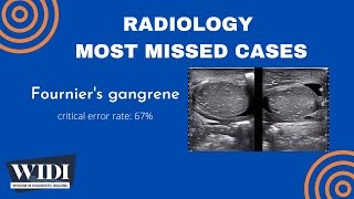 Most Missed Cases: Fournier&#39;s Gangrene