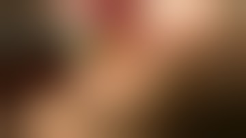 Physics Forceps Extraction of Upper Right Cuspid from GoldenDent, Atraumatic Extraction