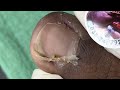 Ep_6518 Ingrown toenail removal 👣 คนเหงื่อออกเท้า จะเป็นแบบนี้ 😄 (clip from Thailand)
