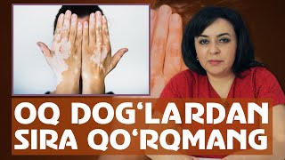 : Oq dog'lar ya'ni vitiligodan sira qo'rqmang - MEDO