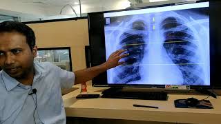 Chest Xray made easy to read  Hindi