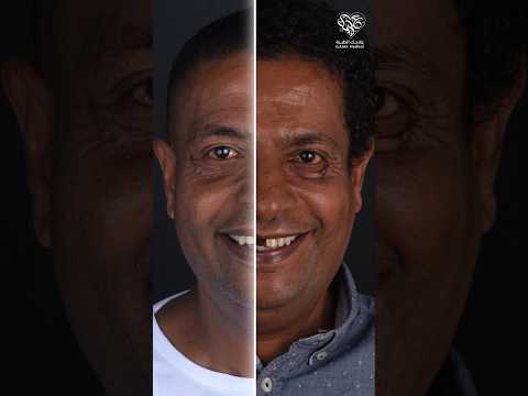 شاهد نتيجة تعويض السن المفقودة زراعة الاسنان قبل وبعد