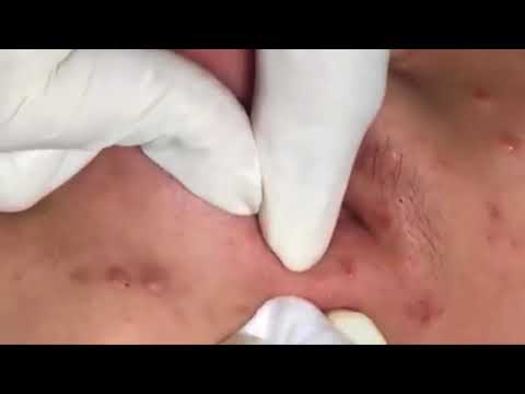 Pimple, Popping, Blackheads, around mouth, acne 