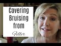 Covering Bruising from Filler (OVER 50)