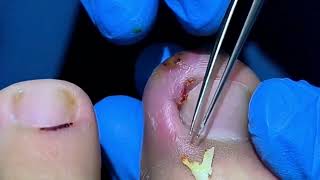 Step by Step To Remove Ingrown Toenails