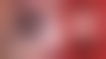 How to Perform Divide and Conquer Cataract Surgery