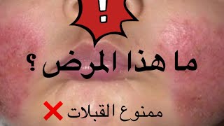 احمرار جلد الرضيع و الحكة / علاج الاكزيما الجلدية / الطفح الجلدي/ECZEMA TREATMENT