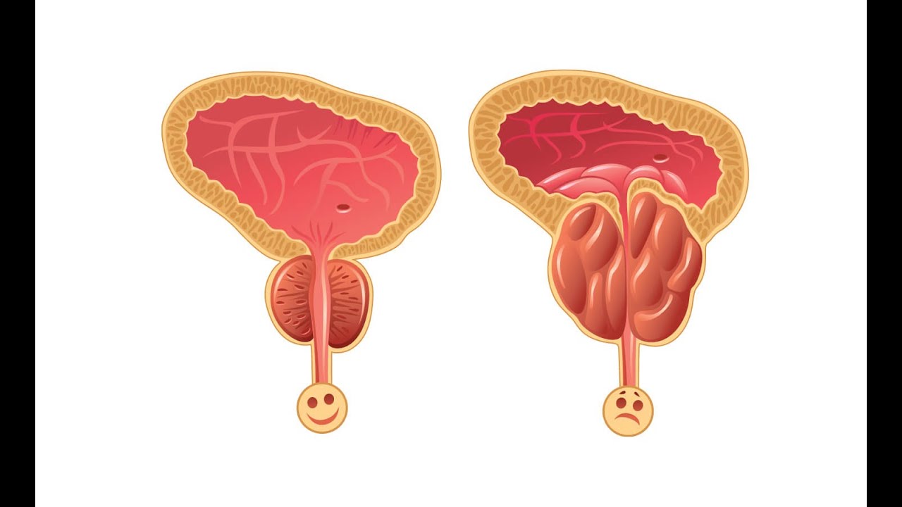 Д простату. Увеличенная простата у мужчин. Простатит вектор. Мочеиспускание при простатите.