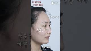 자연스럽게 예뻐지고 싶다면 이거 추천!! 성형외과 직원이 받아 본 퀵코프팅,이마필러 찐후기❤️