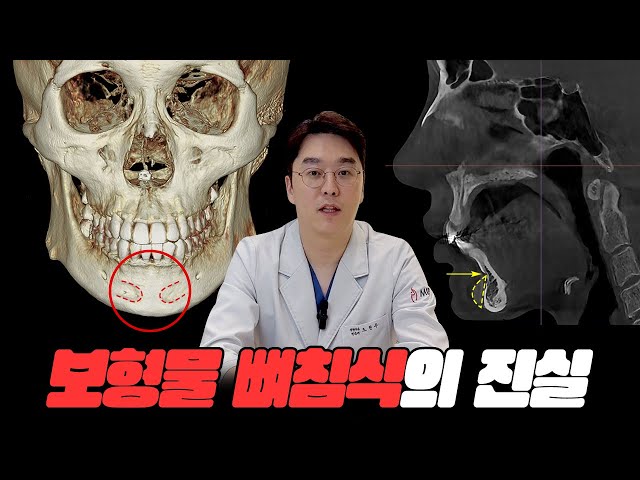 턱끝 필러/보형물 오래 될수록 뼈침식이 더 많이 생길수도 있나요?