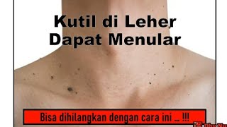 KUTIL DI LEHER - Cara cepat dan ampuh menghilangkan Kutil di Leher