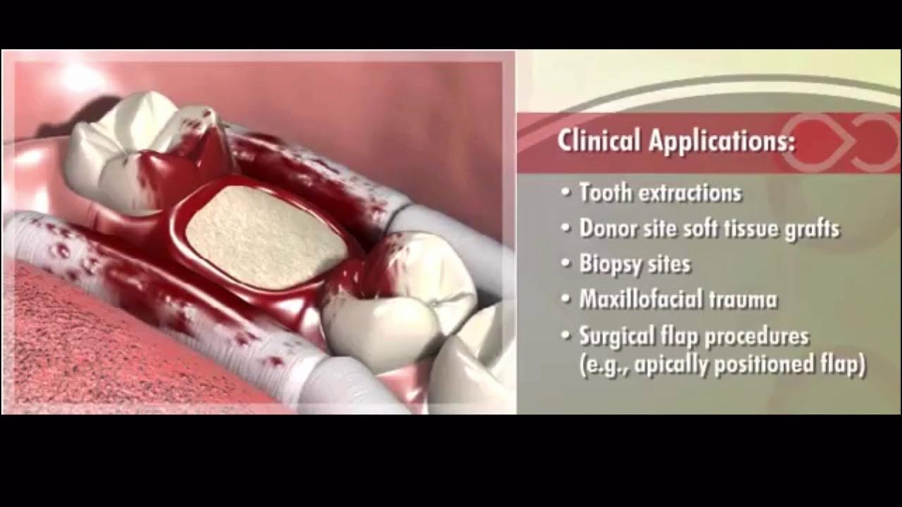 HemCon Dental Dressing Clinical Uses YouTube