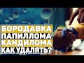 БОРОДАВКИ. ПАПИЛЛОМЫ. КОНДИЛОМЫ. КАК МОЖНО ЗАРАЗИТЬСЯ? СПОСОБЫ ЛЕЧЕНИЯ И УДАЛЕНИЯ (0+)