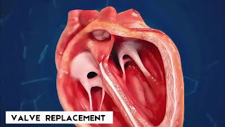 Heart valve replacement | Short Animated Video