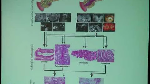O que é Neoplasia papilar Intraductal?