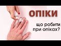 Перша допомога при опіках. Які є опіки? Чи можна проколювати пузирь після опіку? | Ранок надії