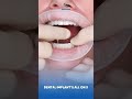 Lower Jaw All-on-X Restoration