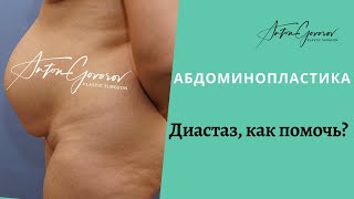 Абдоминопластика. Диастаз, что это такое и как помочь?