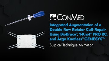 Augmentation of Double Row RCR using BioBrace®, Y-Knot® PRO RC, and Argo Knotless® GENESYS™ - CONMED