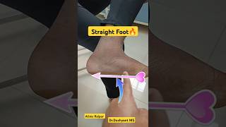 Live 🔥 Flat Foot | सपाट पैर | Straight Foot | #flatfoot