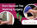 Rare Form of Equinus Toe Walking Surgery Success 6 Month Recovery