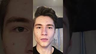 👨‍🦱 Acne Treatment for Men | How to Manage Acne-Prone Skin
