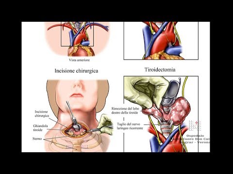 Video: Rimozione Della Ghiandola Tiroidea: Procedura, Rischi E Cure Post-terapia