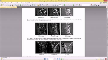 SPINE IMAGE FUSION VIA GRAPH CUTS
