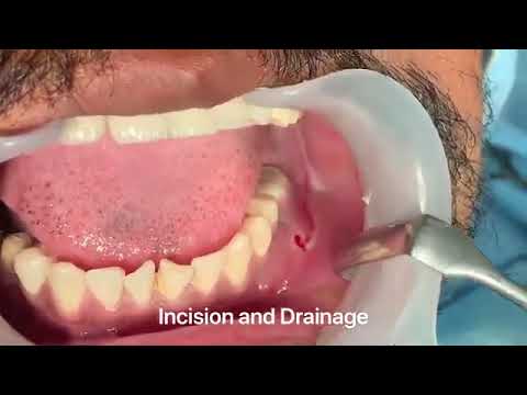 abscess drainage tooth pus incision draining