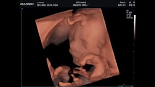 Pretecho 24 Weken, 3D Foto's