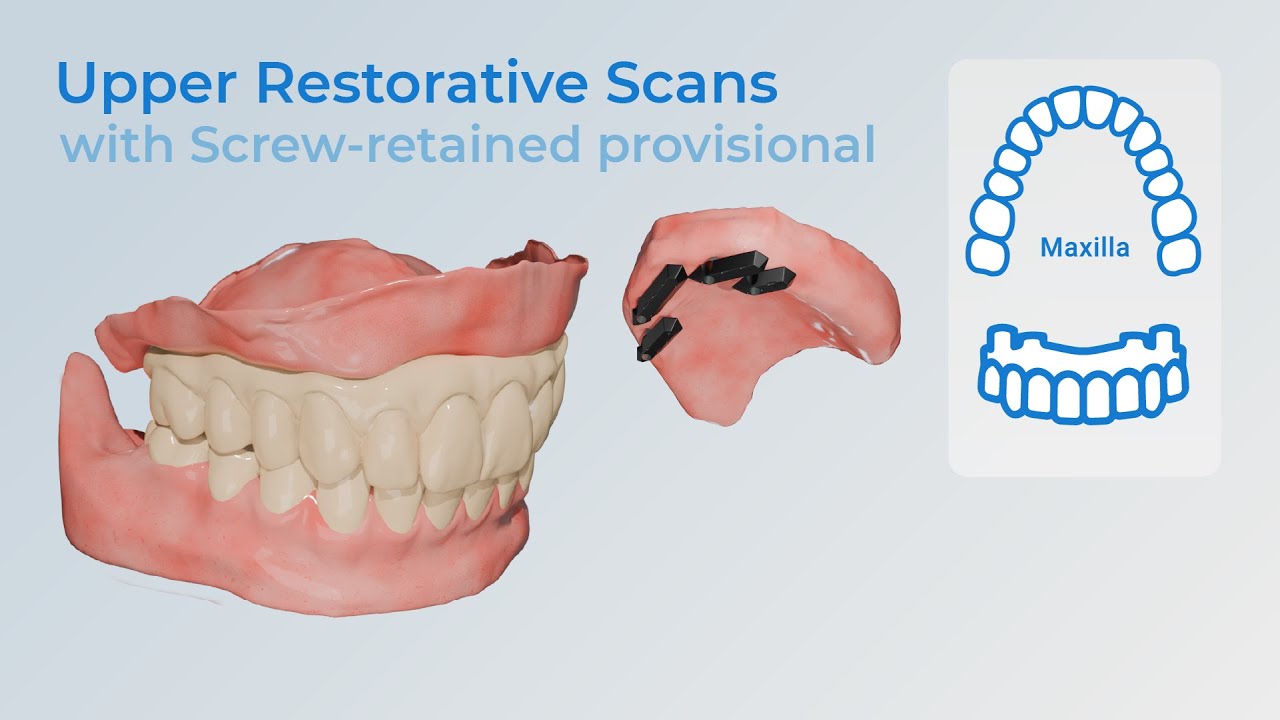 Restorative Full-Arch Protocol from Screw Retained Provisionals: Upper Arch Case