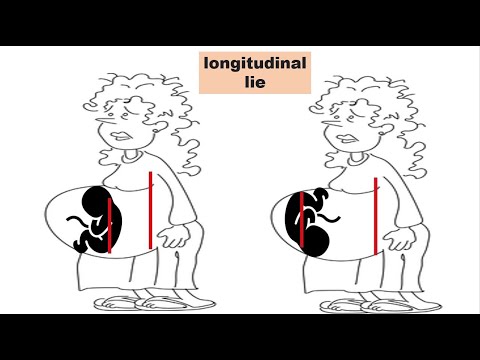 transverse lie presentation meaning in hindi