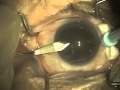 Cataract surgery part 1 of 4  dr david richardson