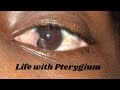 Life w/ Pterygium || Prisye's Diary 