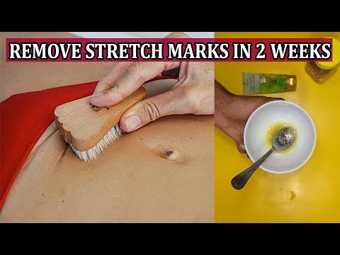 remove-stretch-marks-fast-and-easily-|-pregnancy-stretch-marks-removal-in-2-weeks