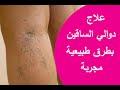 علاج دوالي الساقين بطرق طبيعية مجربة