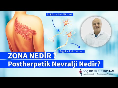 DOÇ.DR. HABİB BOSTAN - ZONA HASTALIĞI NEDİR ? TEDAVİ YÖNTEMİ NELERDİR ?POSTHERPETİK NEVRALJİ NEDİR ?