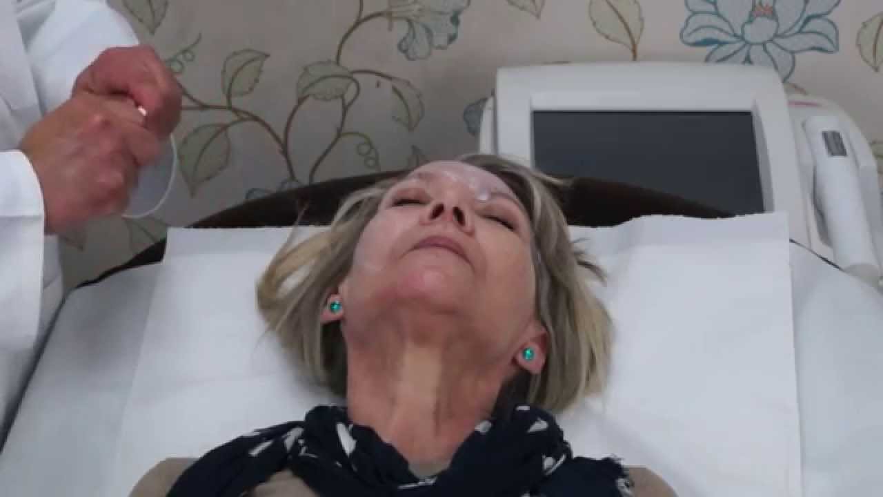 PDO Thread Lift Treatment YouTube