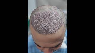 Hair Transplant Grsft Placement / Best Hair Transplant / DHT/ Hair Transplant in Nepal